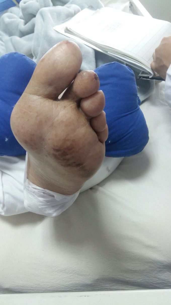 How a diabetic foot started 