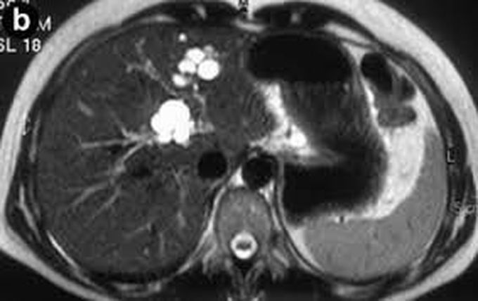 Causes of carolis disease