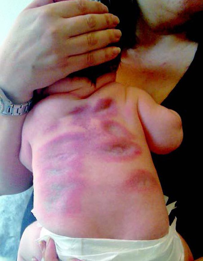 What is the most likely cause of these skin lesions in an otherwise healthy infant?