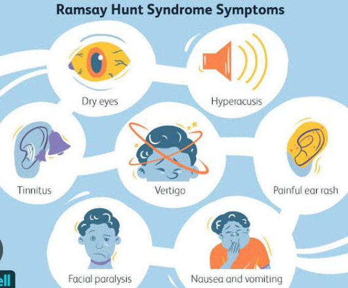 Symptoms of Ramsay Hunt syndrome