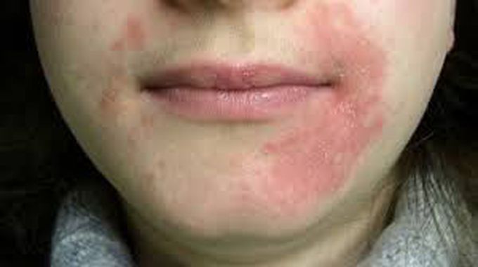 Symptoms of perioral dermatitis