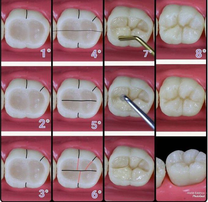 Class 1 cavity- composite