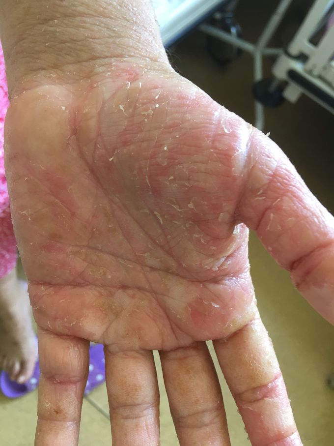 HIV positive female patient after sespis