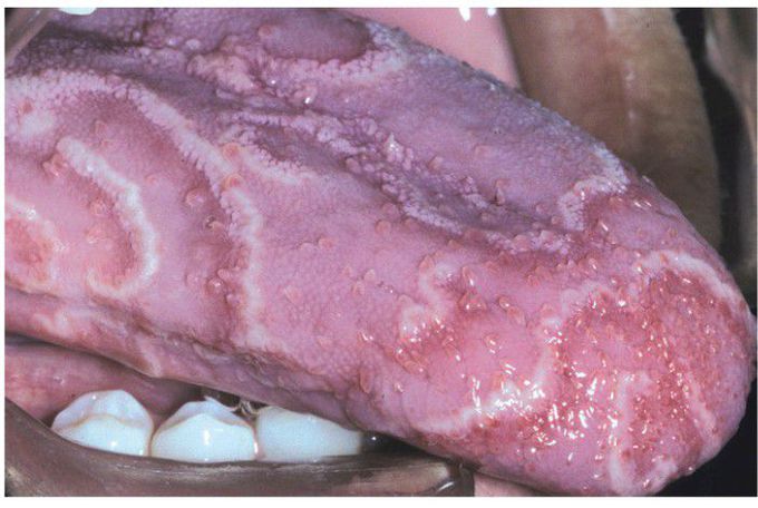 Erythema Migrans.