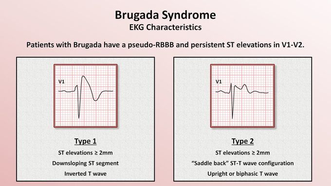 What are the symptoms of Brugada syndrome?