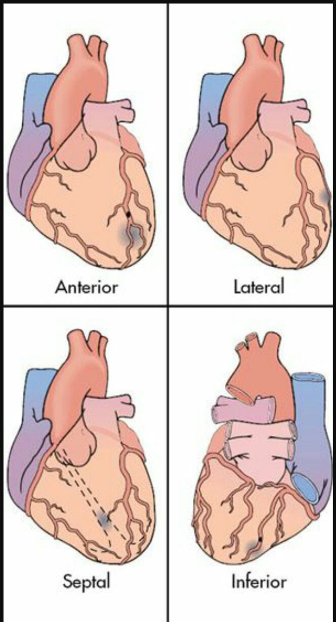 types-of-myocardial-infarction-medizzy
