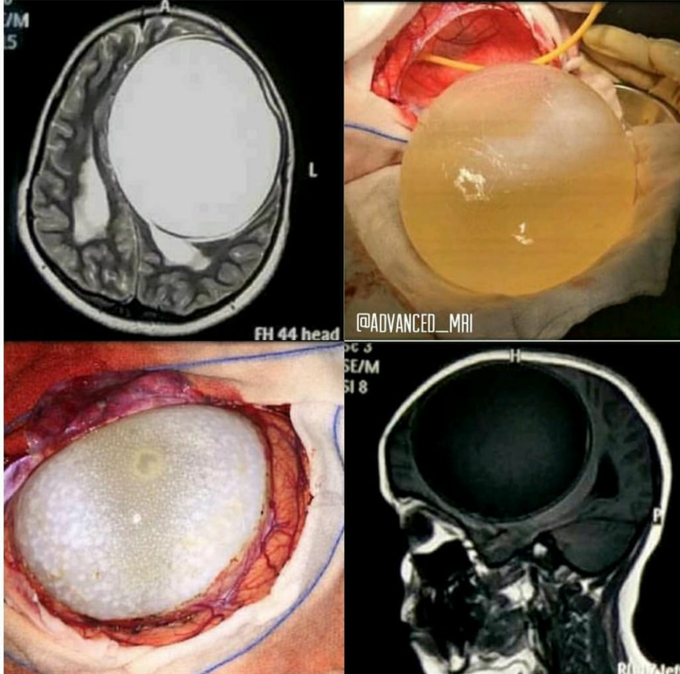 Huge cyst in brain