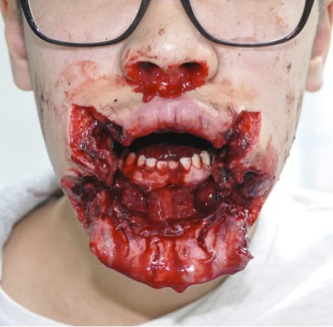 Facial injury
