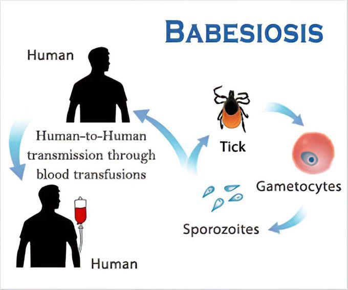 Babesiosis symptoms