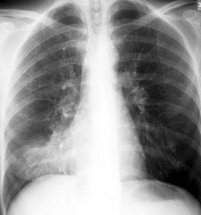 Typical Bacterial Pneumonia