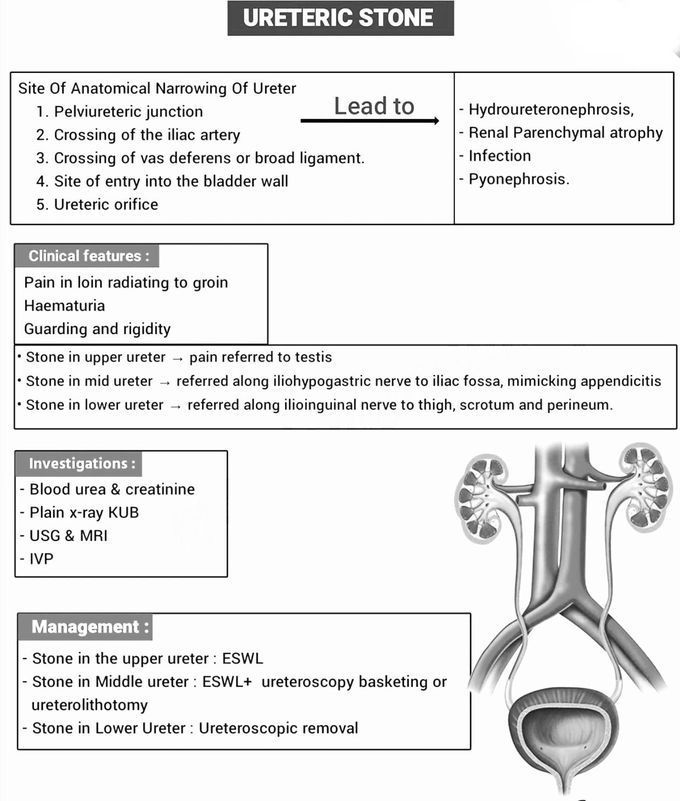 Ureteric stone