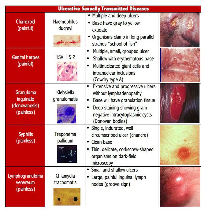 Ulcerative sexually transmitted diseases
