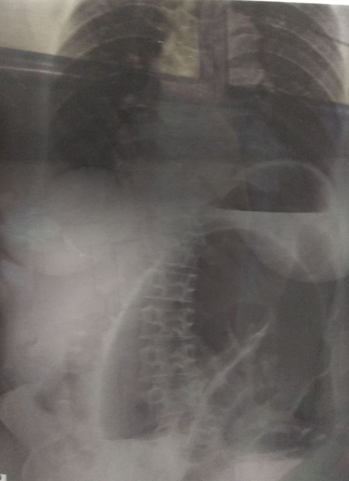 50 years male with pain abdomen and vomiting.. Diagnosis??