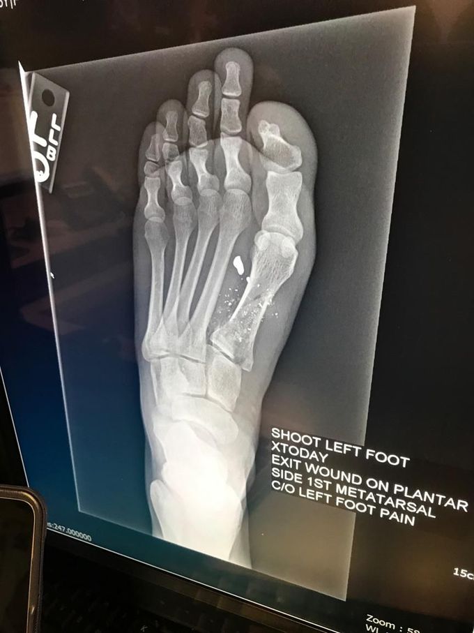 Gunshot Xray