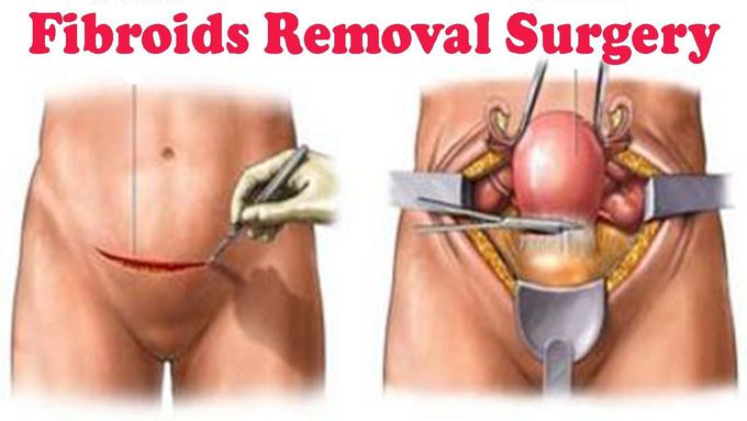 Image: Cure For Uterine Fibroids Permanently | Fibroids Removal Surgery ...