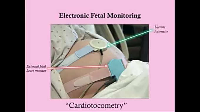 Cardiotocomerty