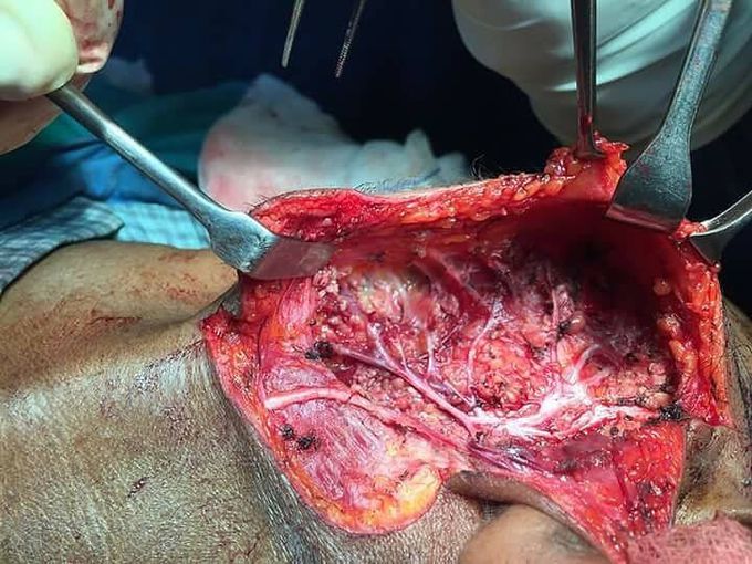 Picture of facial nerve and greater auricular nerve after superficial parotidectomy 