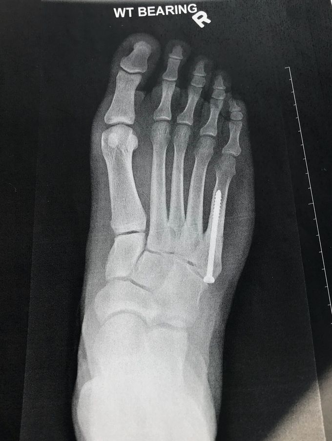 5th metatarsal repair surgery, 4 months post op