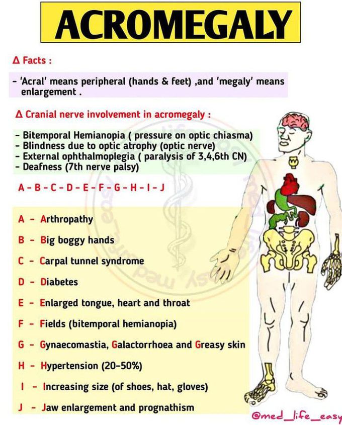 Acromegaly