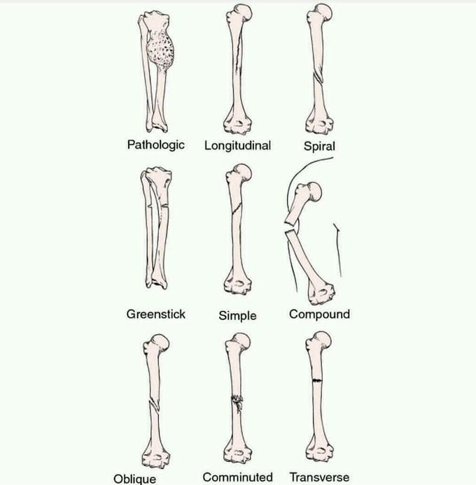 Type of bone fracture