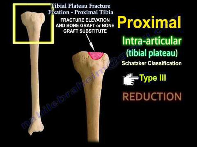 Tibial Plateau Fracture Fixation, Proximal Tibia - Everything You Need To Know - Dr. Nabil Ebraheim