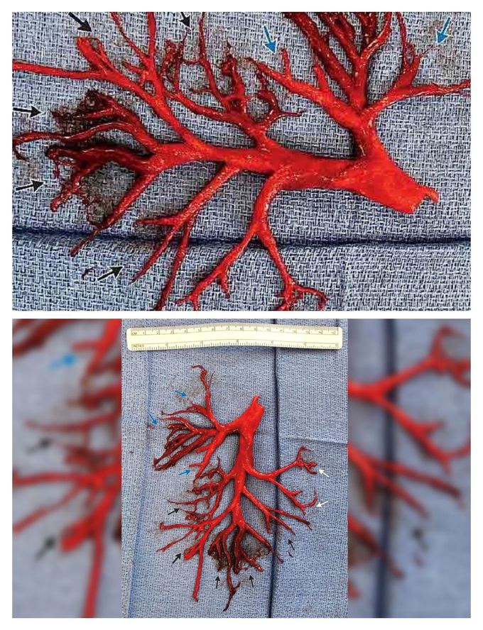 A blood clot formed in the exact shape of a man's lung passage - then he  coughed it up