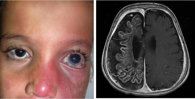 Sturge-Weber Syndrome and its Manifestations in Skin, Brain, and Eyes