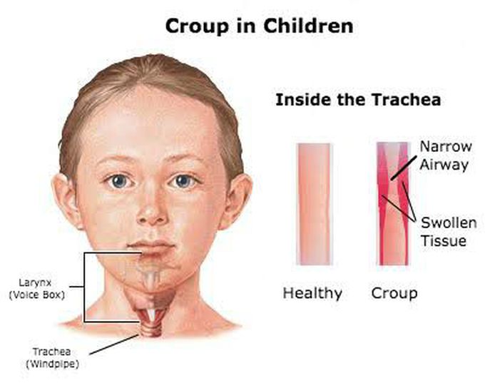 Croup in children