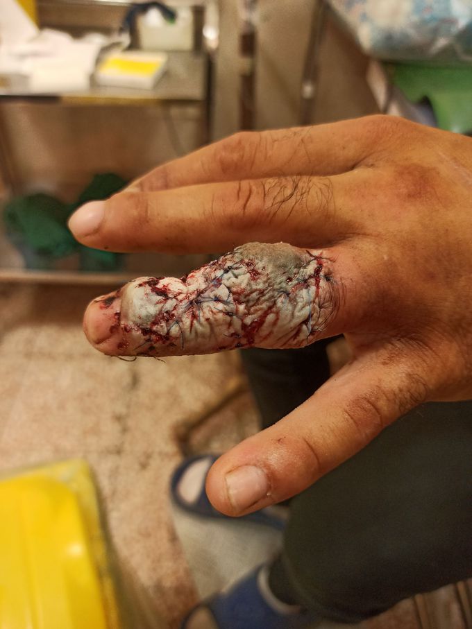 The finger of a person bitten by a poisonous snake