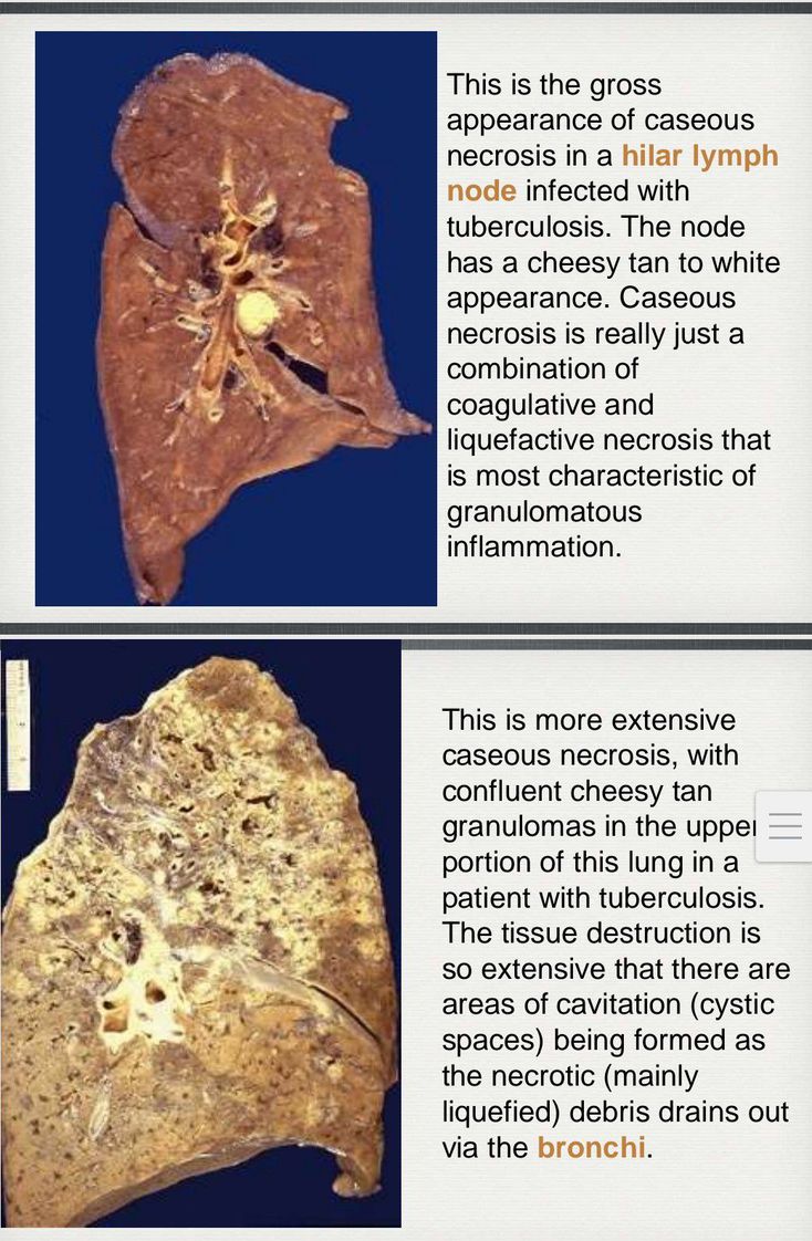 caseous necrosis