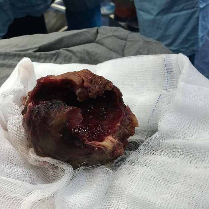 Abdominal Aortic Aneurysm (AAA)