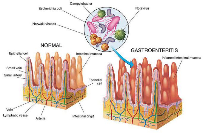 causes of gastroenteritis