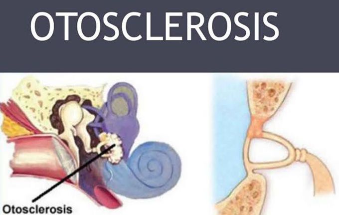 Otosclerosis