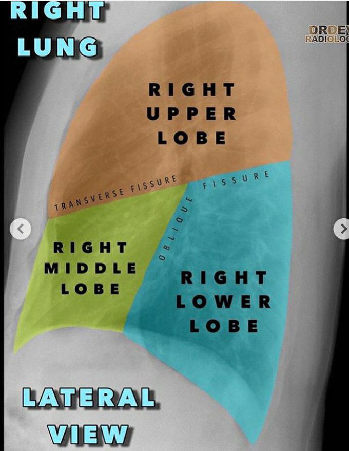 CXR notes to be continued...