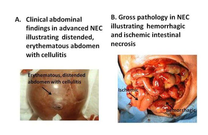 OVERVIEW: What every practitioner needs to know

Are you sure your patient has necrotizing enterocolitis (NEC)? What are the typical findings for this disease?