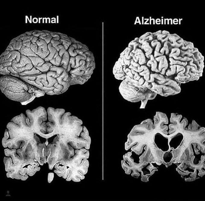 Changes occur in brain in alzheimer’s disease