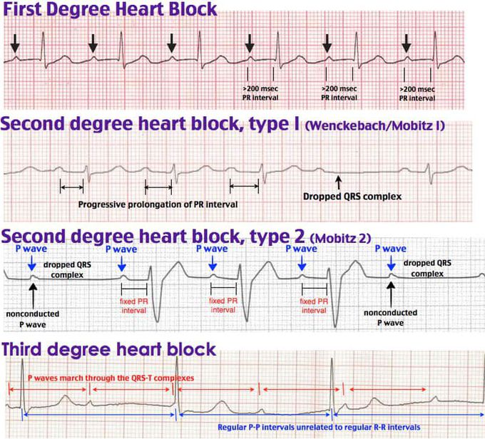 (To Aishah 🌸)(Part 1)🤓Atrioventricular (AV) block
Aka heart block.

Causes
Idiopathic
RCA infarct (inferior MI), as this supplies the AV node.
Myocarditis
Drugs: β-blockers, calcium channel blockers, adenosine, digoxin, cholinesterase inhibitors.
1st degree AV block
Prolonged PR interval (>0.2 seconds, 5 small squares).
No treatment required.
2nd degree AV block
Intermittent conduction of the P wave to the ventricles.
The conduction ratio is the number of P waves to QRS complexes e.g. 4:3.
A conduction ratio of 2:1 is untypable as it is hard to determine if there is progressive PR prolongation.
High grade 2nd degree block is when 2 consecutive P waves fail to conduct to the ventricles.
The P waves are regular, distinguishing it from ectopic atrial contractions.
2nd degree AV block type 1
Aka Mobitz type 1, or Wenckebach.
Progressively prolonged PR interval until a P wave fails to transmit to the ventricles.
No treatment required.
Can sometimes be hard to distinguish from Mobitz type 2 when increases in PR are small. Look for the biggest increase, which is between the 1st and 2nd PR after the missed QRS.
2nd degree AV block type 2
Aka Mobitz type 2.
Constant PR interval but intermittent failure to transmit to the ventricles.
High risk of progression to 3rd degree block so often requires pacemaker treatment.
3rd degree AV block
Aka complete heart block.
No transmission of P waves into ventricles, with a ventricular escape rhythm taking over.
QRS is usually wide, but occasionally the bundle of His provides the pacemaker and thus the QRS is narrow.
HR 20-40.
This is one cause of AV dissociation. Others include accelerated idioventricular rhythm (ectopic focus in ventricles with HR 50-110) and VT.
Requires pacemaker.........................................Bundle branch blocks
General features
Blockage in the bundle branches, which lie between the bundle of His and the Purkinje fibres.
Depolarisation instead spreads via the (slower) myocardium, causing broad QRS complexes.
The altered depolarisation sequence also leads to altered repolarisation, and hence ST-T changes.
Left bundle branch block (LBBB)
Causes:

Anterior MI (LAD). May be the initial ECG sign.
HTN
Myocarditis
Cardiomyopathy
Aortic valve disease.
ECG:

Deep, wide S in V1 and RSR' (M-shaped) in V6: SLaM (LBBB).
V1: delayed LV depolarisation results in a deep, wide S wave.
V6: right to left septal depolarisation, instead of the usual left to right, leads to initial R wave in V6 followed by a dip during RV depolarisation, then 2nd R wave as depolarisation reaches the LV. Same pattern seen in lead I. Often the middle notch of the M is very small, such that it simply looks like a broad R wave.
Discordant T waves in V1 and V6.
Criteria: {broad QRS} + {broad R in V6} + {broad S in V1 or 2}.
Right bundle branch block (RBBB)
Causes:

Increased RV pressure: primary pulmonary HTN, cor pulmonale, PE.
Acquired heart disease: anterior MI (LAD), myocarditis, cardiomyopathy.
Congenital
Iatrogenic e.g. cardiac catheterisation.
Can also be a normal ECG variant in healthy individuals.
ECG:

rSR in V1 (M-shaped) and QRS (W-shaped) in V6: MaRroW (RBBB).
Electrophysiology: the initial rS (V1) and QR (V6) reflect a normal left to right septal depolarisation and LV depolarisation. The delayed RV depolarisation leads to a 2nd broad R wave in V1 and a late 'slurred' S wave in V6.
Instead of rSR, sometimes V1 simply has one large R ± a small notch as it rises.
Criteria: {broad QRS} + {slurred S V6 and/or rSR V1} + {overall +ve QRS in V1}.
Left anterior and posterior fascicular block
Blockage in one of the two branches of the left bundle branch.
LAFB is much commoner, and in isolation may simply be a benign feature of aging. Other causes include anterior MI, IHD, aortic valve disease, HTN, or cardiomyopathy.
LPFB is associated with inferior MI or cardiomyopathy.
Aka left anterior and posterior hemiblocks.
ECG
QRS normal or slightly prolonged (80-120 ms).

LAFB:

Left axis deviation.
Small Q and tall R (qR pattern) in lateral leads (I and aVL) with prolonged R peak time (>45 ms) in aVL.
Small R and deep S (rS pattern) in inferior leads.
LPFB is the opposite:

Right axis deviation.
Small R and deep S in lateral leads.
Small Q and tall R in inferior leads, with prolonged R peak time in aVF.
Bifasciular and trifascicular block
Bifascicular block:

RBBB plus {LAFB or LPFB}. Conduction is via the single remaining fascicle.
ECG: RBBB plus left or right axis deviation.
Causes: IHD (50%), HTN (25%), aortic stenosis, anterior MI, congenital, ↑K+.
Clinical significance uncertain, but carries a 1% annual risk of progression to complete heart block.
Trifascicular block:

May not be a clinically useful term. It implies blockage in right bundle plus both fascicles, which is essentially just 3rd degree AV block.
In practice, it may be used to describe an incomplete trifascicular block where there is still partial/intermittent transmission in one of the fascicles, plus associated 1st/2nd degree AV block. Resulting ECG shows RBBB, LAFB or LPFB, and prolonged PR.