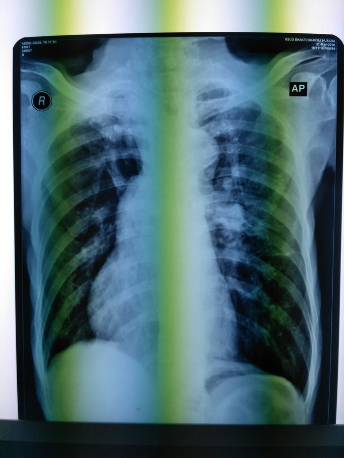 Thorax X-ray PA