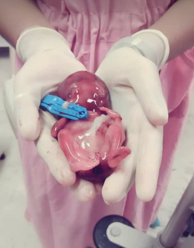 12 Weeks aborted fetus