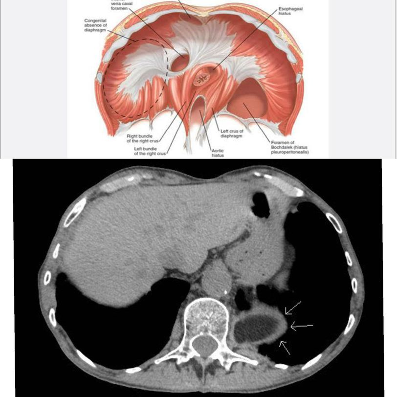 Bochdalek Hernia - MEDizzy