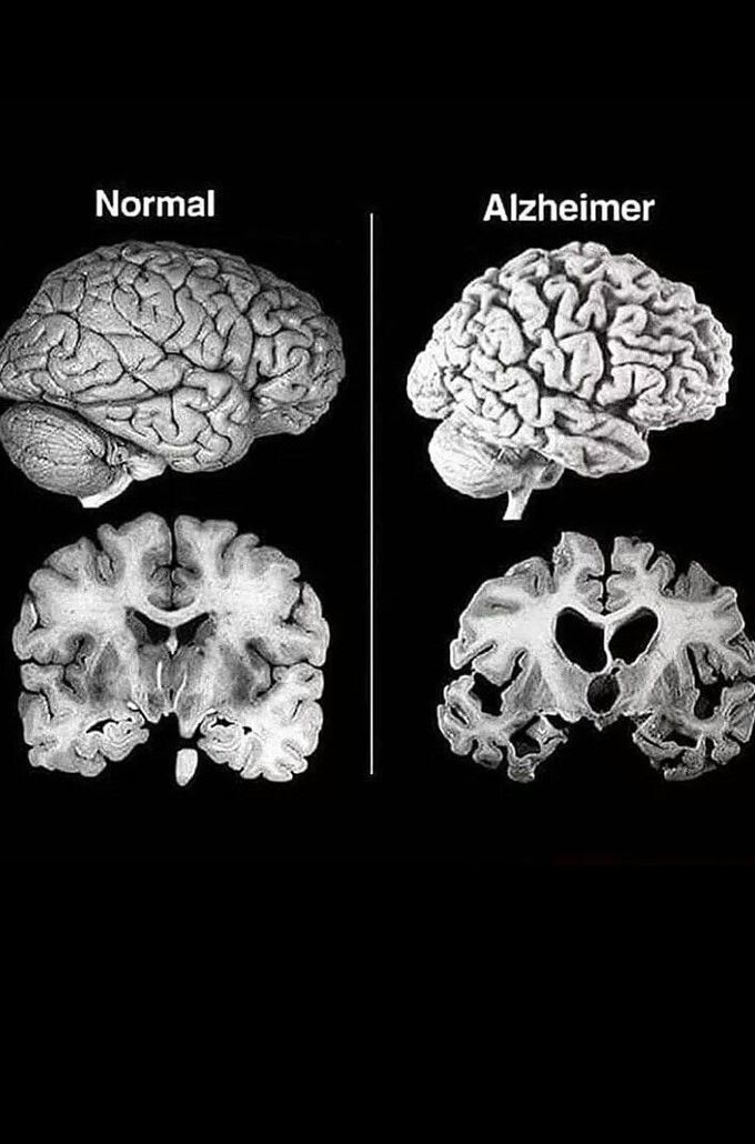 Alzheimer's disease accounts for 60-70% cases of dementia.