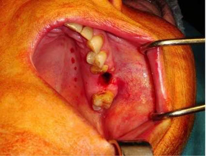 Oroantral fistula (oromaxillary fistula)