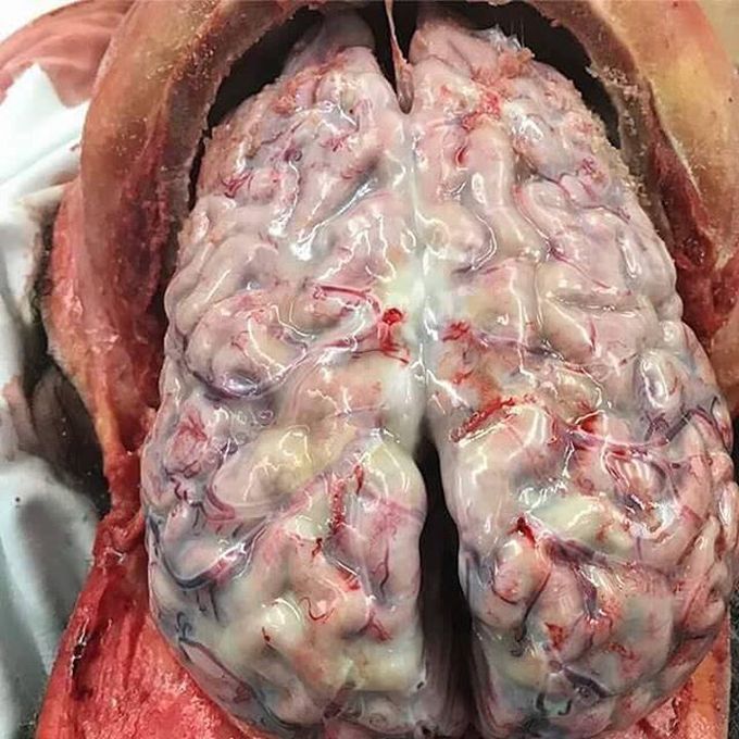 Bacterial Meningitis with Pus Formation