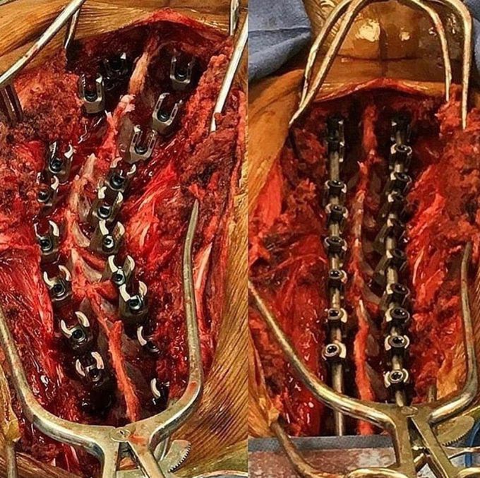 Intraoperative view of scoliosis surgery, before and after the alignment!