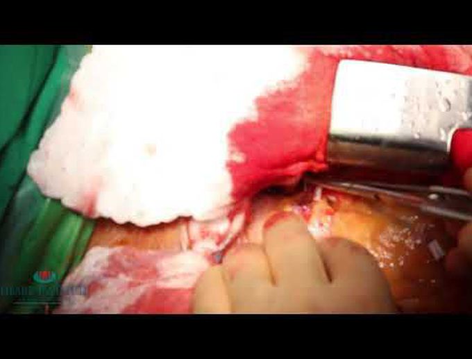 Off-Pump Surgical Epicardial Closure of Left Anterior Descending to Pulmonary Artery Fistula