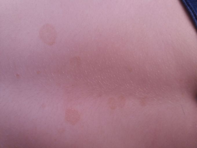 Dx and tratment #dermato