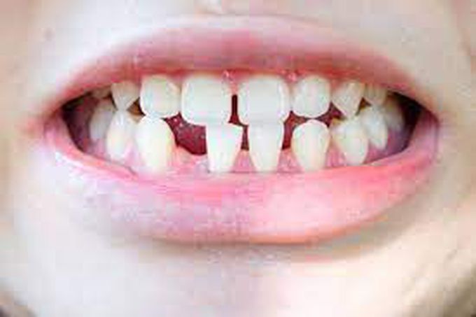 What causes hypodontia?