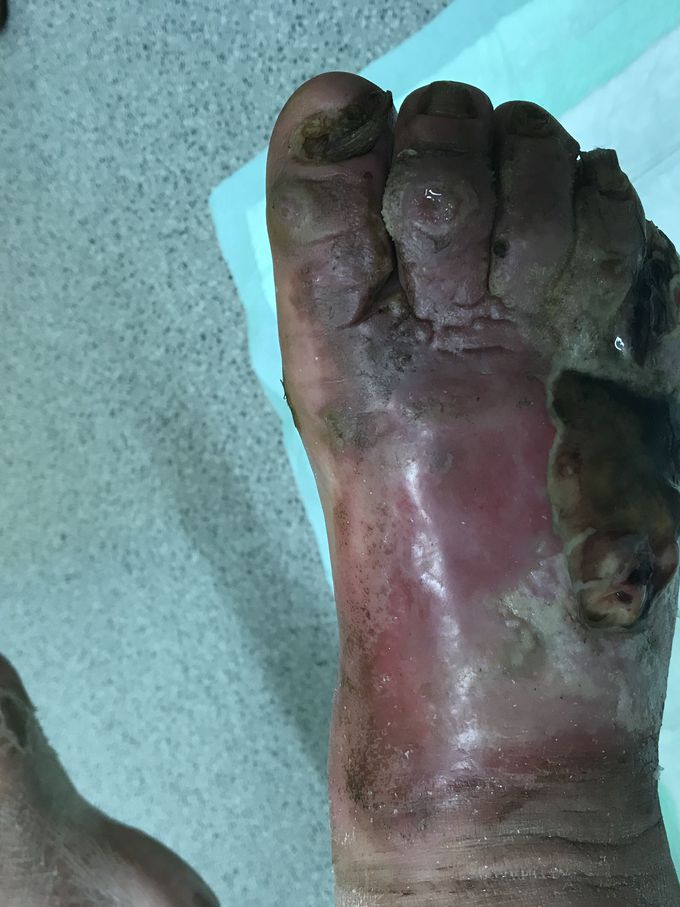 Diabetic foot