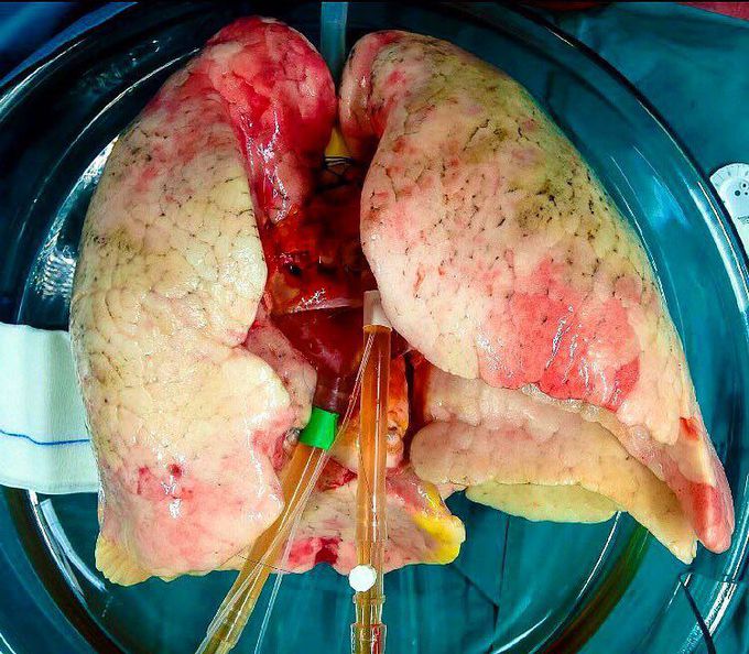 Fresh lungs being prepared for transplantation!!