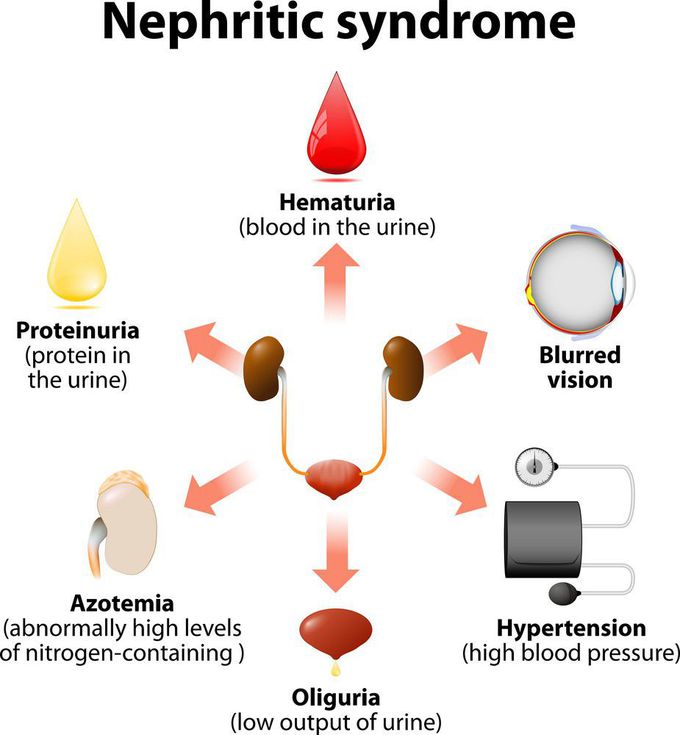 Nephritic syndrome.